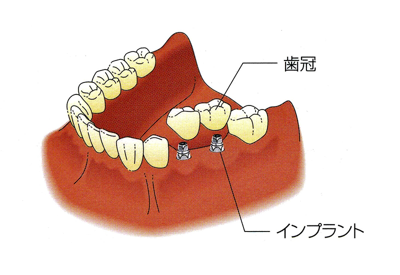 インプラント