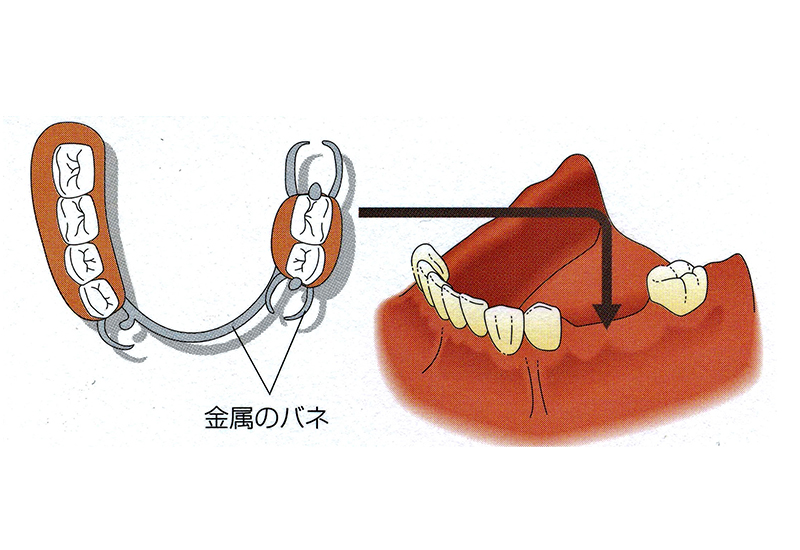 入れ歯